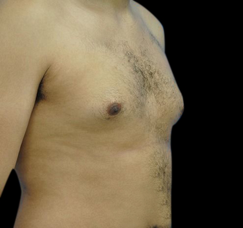 New Jersey Gynecomastia Before & After Gallery - Patient 55432624 - Image 3