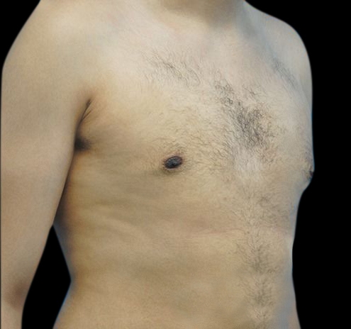 New Jersey Gynecomastia Before & After Gallery - Patient 55432624 - Image 4