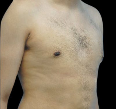 New Jersey Gynecomastia Before & After Gallery - Patient 55432624 - Image 4