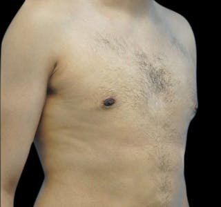 Gynecomastia Before & After Gallery - Patient 55432624 - Image 4