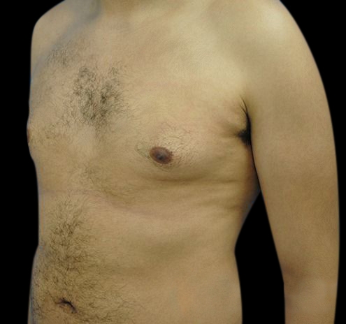 New Jersey Gynecomastia Before & After Gallery - Patient 55432624 - Image 5