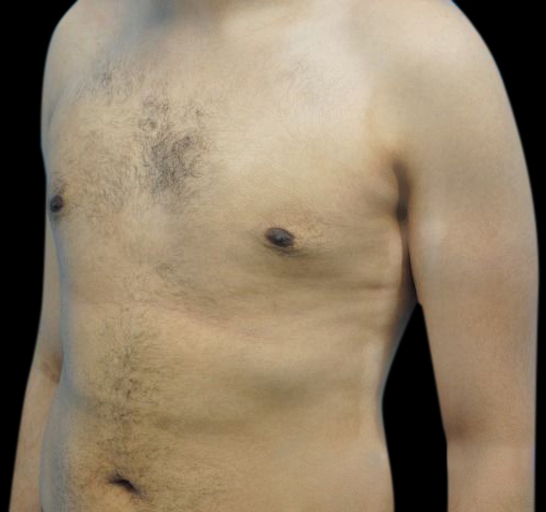 New Jersey Gynecomastia Before & After Gallery - Patient 55432624 - Image 6