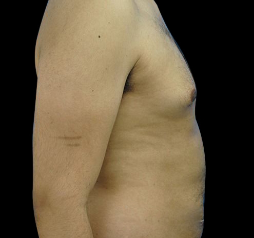 New Jersey Gynecomastia Before & After Gallery - Patient 55432624 - Image 7