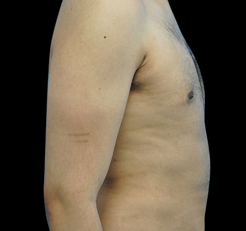 Gynecomastia Before & After Gallery - Patient 55432624 - Image 8