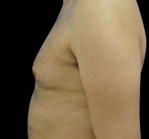New Jersey Gynecomastia Before & After Gallery - Patient 55432624 - Image 9