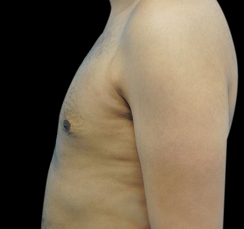 Gynecomastia Before & After Gallery - Patient 55432624 - Image 10