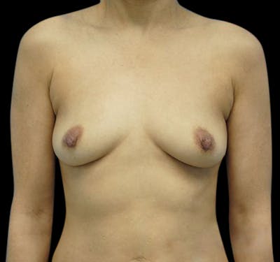 New Jersey Breast Augmentation Before & After Gallery - Patient 55432631 - Image 1