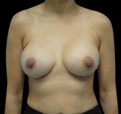 New Jersey Breast Augmentation Before & After Gallery - Patient 55432631 - Image 2