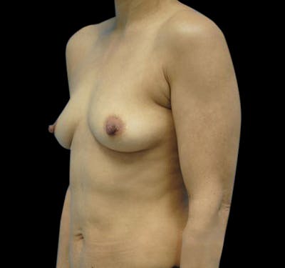 Breast Augmentation Before & After Gallery - Patient 55432631 - Image 3