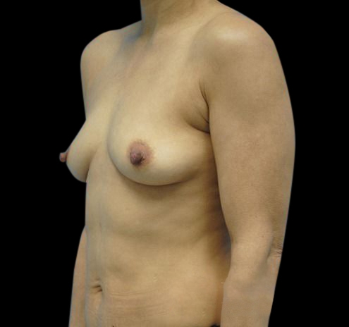 New Jersey Breast Augmentation Before & After Gallery - Patient 55432631 - Image 3