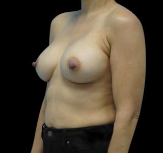 New Jersey Breast Augmentation Before & After Gallery - Patient 55432631 - Image 4