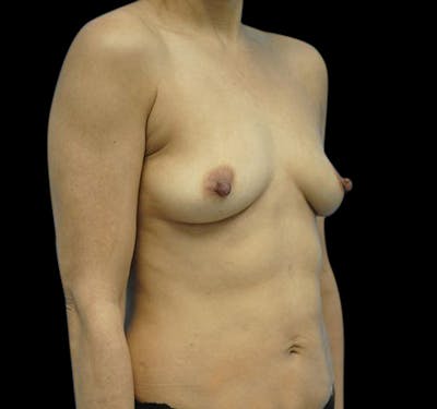 New Jersey Breast Augmentation Before & After Gallery - Patient 55432631 - Image 5