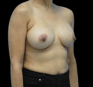 Breast Augmentation Before & After Gallery - Patient 55432631 - Image 6