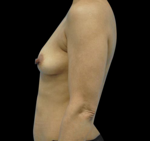 New Jersey Breast Augmentation Before & After Gallery - Patient 55432631 - Image 7