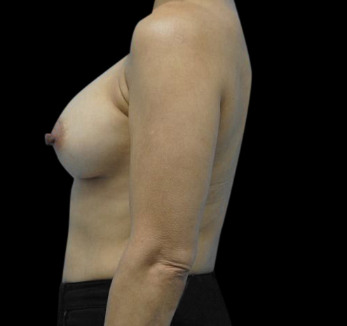 Breast Augmentation Before & After Gallery - Patient 55432631 - Image 8