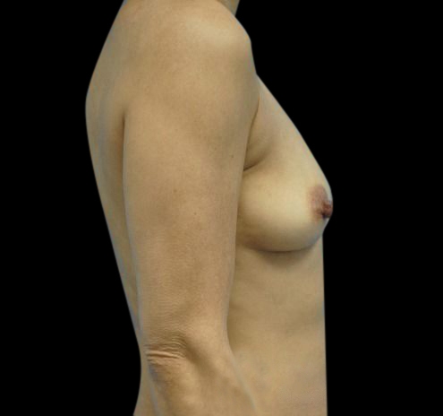 New Jersey Breast Augmentation Before & After Gallery - Patient 55432631 - Image 9