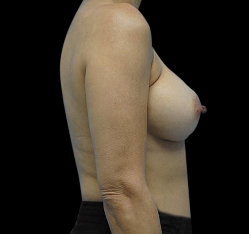 New Jersey Breast Augmentation Before & After Gallery - Patient 55432631 - Image 10