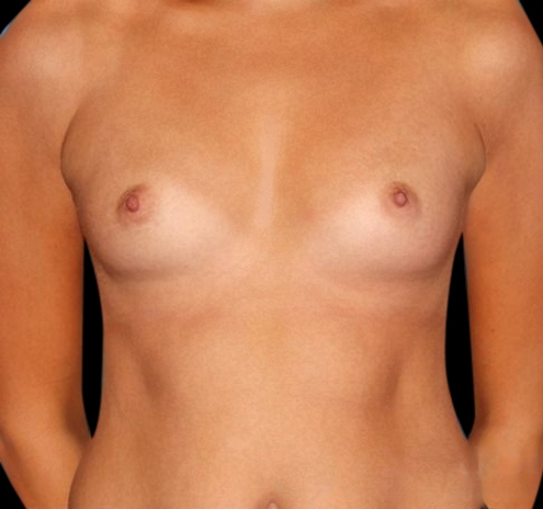 Breast Augmentation Before & After Gallery - Patient 55432633 - Image 1