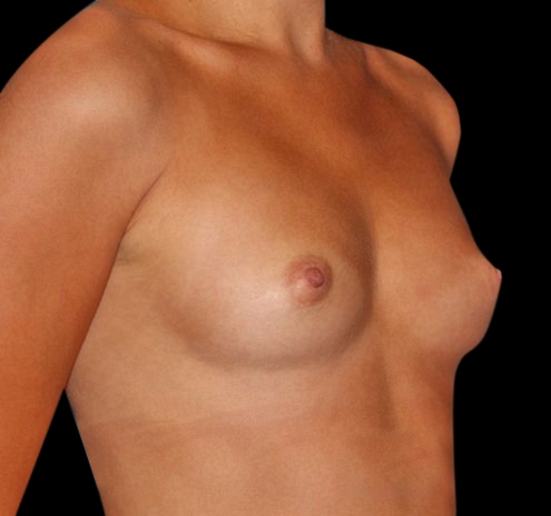Breast Augmentation Before & After Gallery - Patient 55432633 - Image 3