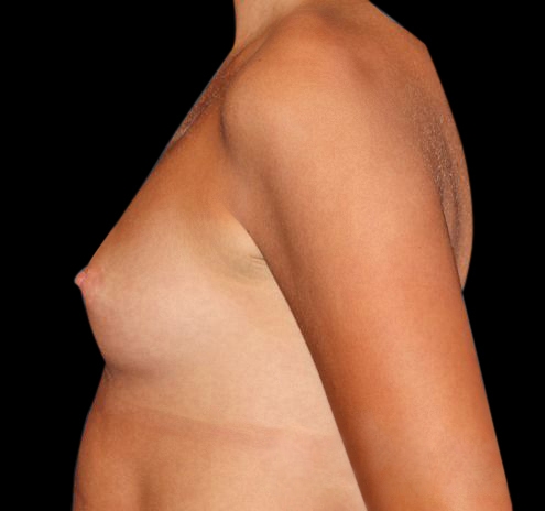 New Jersey Breast Augmentation Before & After Gallery - Patient 55432633 - Image 5