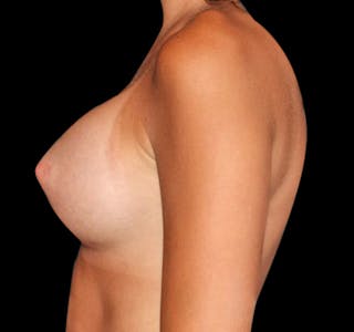 New Jersey Breast Augmentation Before & After Gallery - Patient 55432633 - Image 6