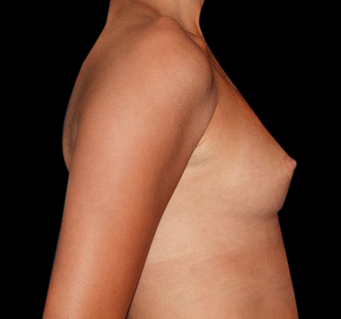 Breast Augmentation Before & After Gallery - Patient 55432633 - Image 9