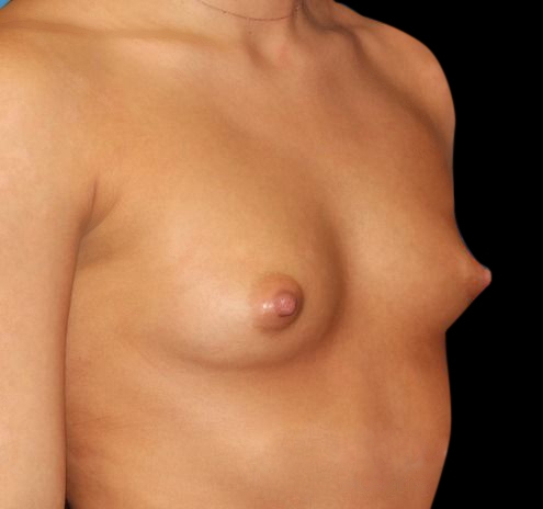 New Jersey Breast Augmentation Before & After Gallery - Patient 55432634 - Image 3
