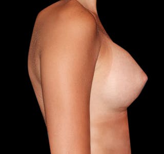 New Jersey Breast Augmentation Before & After Gallery - Patient 55432633 - Image 10