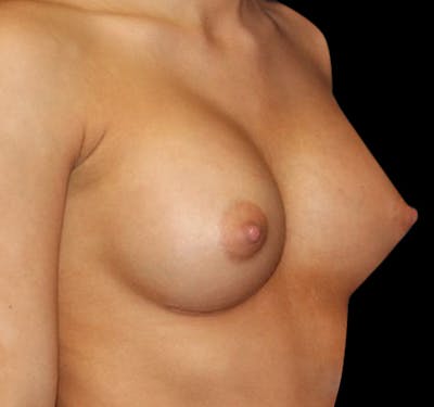New Jersey Breast Augmentation Before & After Gallery - Patient 55432634 - Image 4