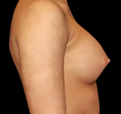 New Jersey Breast Augmentation Before & After Gallery - Patient 55432634 - Image 6