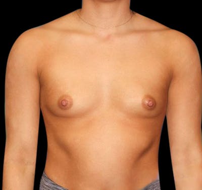 New Jersey Breast Augmentation Before & After Gallery - Patient 55432634 - Image 1