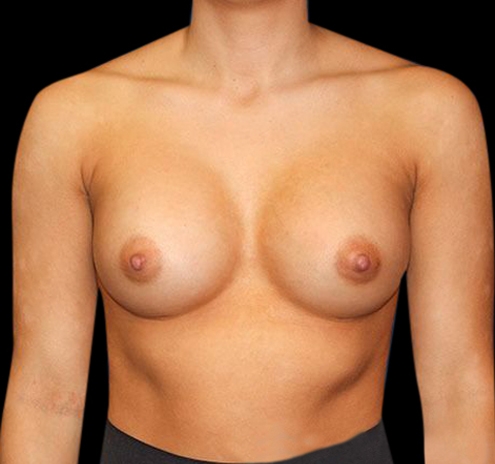New Jersey Breast Augmentation Before & After Gallery - Patient 55432634 - Image 2