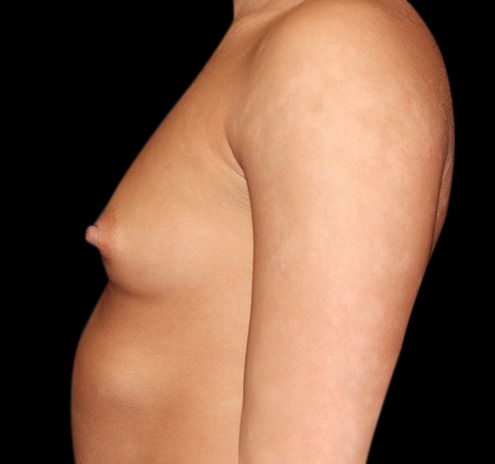 New Jersey Breast Augmentation Before & After Gallery - Patient 55432634 - Image 7