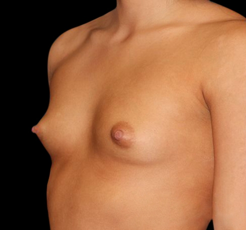 New Jersey Breast Augmentation Before & After Gallery - Patient 55432634 - Image 9