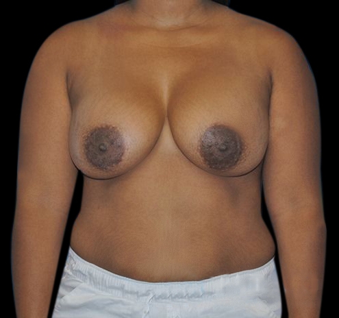 New Jersey Breast Augmentation Before & After Gallery - Patient 55432636 - Image 2