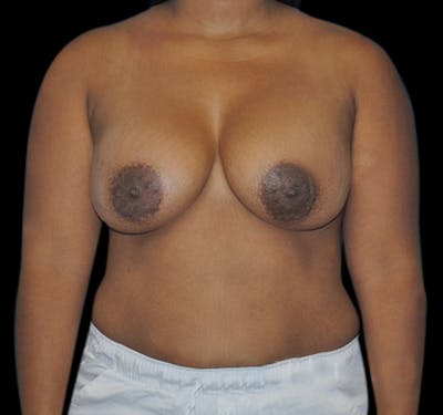 Breast Augmentation Before & After Gallery - Patient 55432636 - Image 2