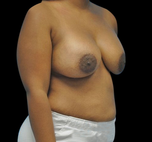 Breast Augmentation Before & After Gallery - Patient 55432636 - Image 4