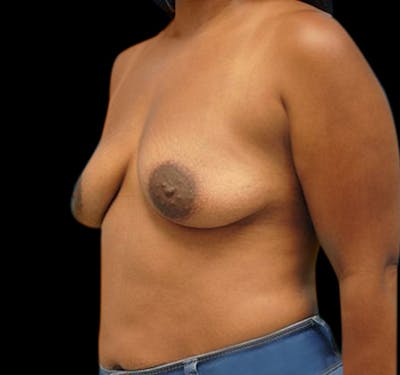 New Jersey Breast Augmentation Before & After Gallery - Patient 55432636 - Image 5