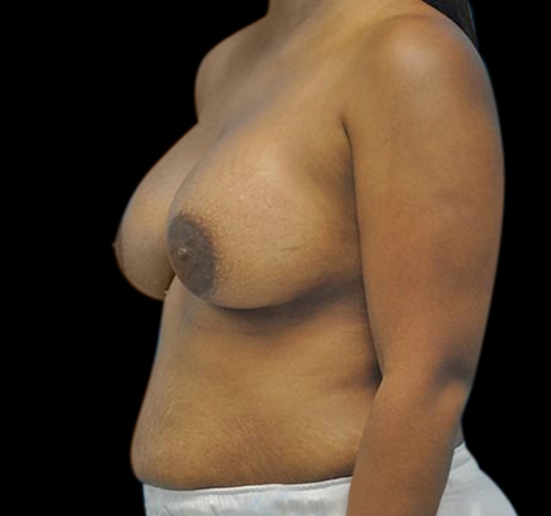 New Jersey Breast Augmentation Before & After Gallery - Patient 55432636 - Image 6