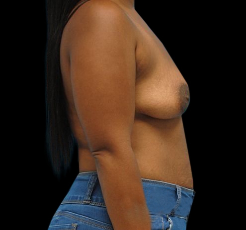 New Jersey Breast Augmentation Before & After Gallery - Patient 55432636 - Image 7