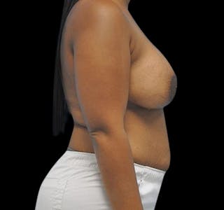 New Jersey Breast Augmentation Before & After Gallery - Patient 55432636 - Image 8
