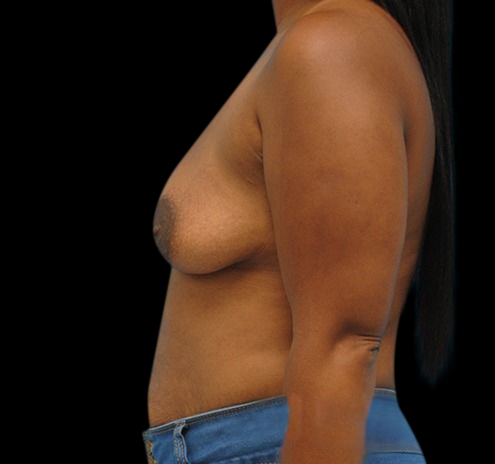 Breast Augmentation Before & After Gallery - Patient 55432636 - Image 9