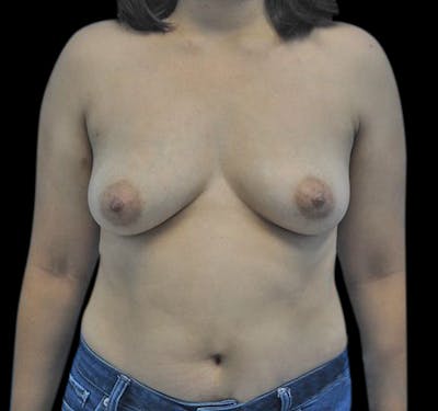 New Jersey Breast Augmentation Before & After Gallery - Patient 55432638 - Image 1
