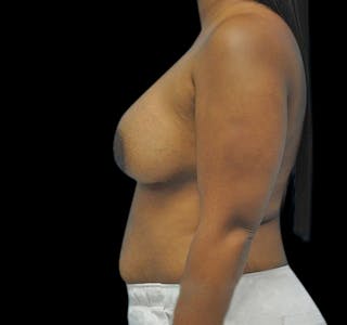 Breast Augmentation Before & After Gallery - Patient 55432636 - Image 10