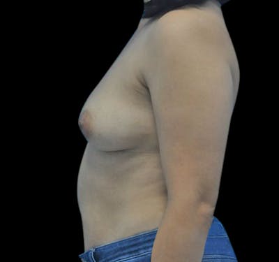 New Jersey Breast Augmentation Before & After Gallery - Patient 55432638 - Image 3