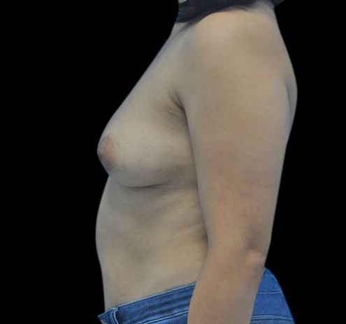 Breast Augmentation Before & After Gallery - Patient 55432638 - Image 3