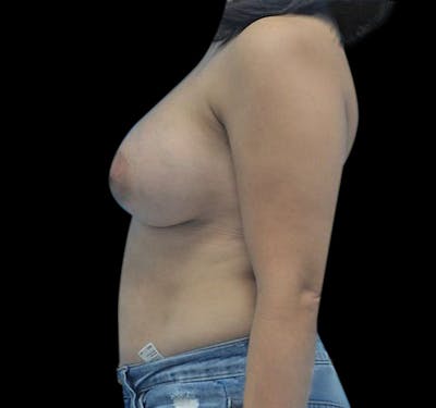 New Jersey Breast Augmentation Before & After Gallery - Patient 55432638 - Image 4