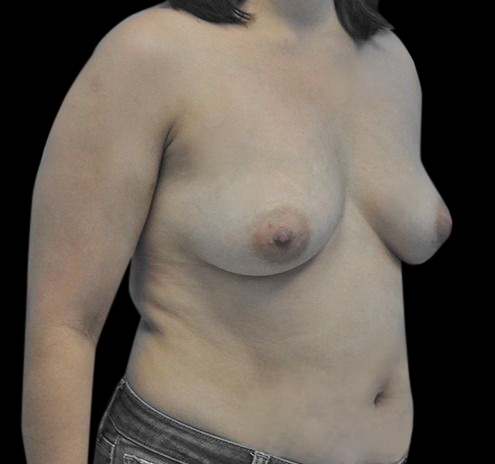 New Jersey Breast Augmentation Before & After Gallery - Patient 55432638 - Image 7