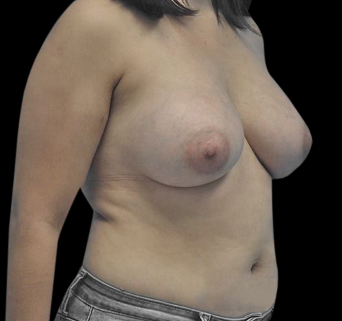 Breast Augmentation Before & After Gallery - Patient 55432638 - Image 8