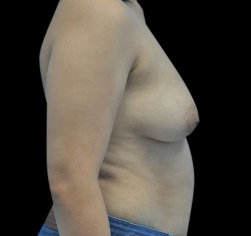 New Jersey Breast Augmentation Before & After Gallery - Patient 55432638 - Image 9